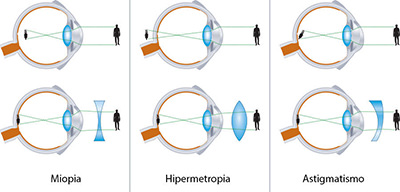 Opticlass Timisoara - Miopia, Hipermetropia, Astigmatismul, Prezbiopia